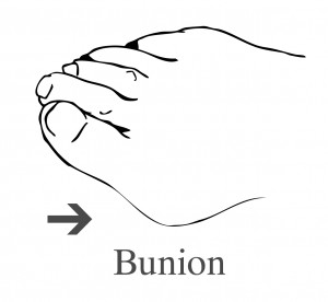 bunion bunion