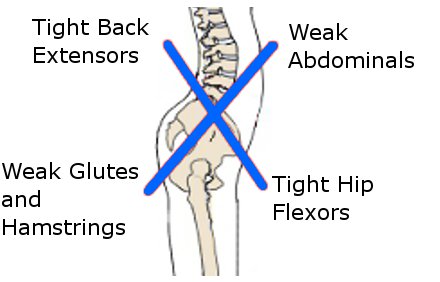 Flat Feet Anterior Pelvic Tilt