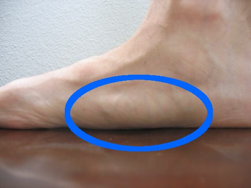 Flat Feet Arch Flab