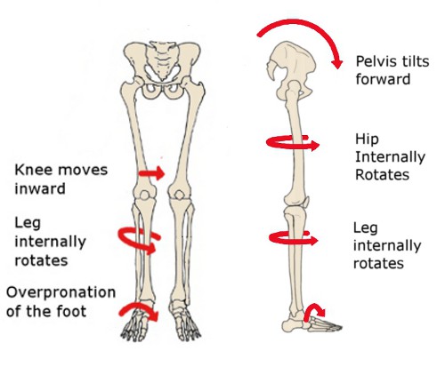 Anterior Pelvic Tilt Flat Feet