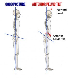 Anterior Pelvic Tilt 1