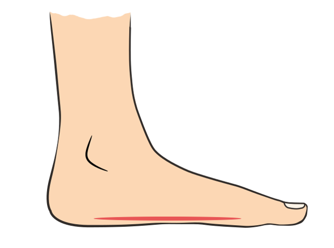 flat-foot-660a