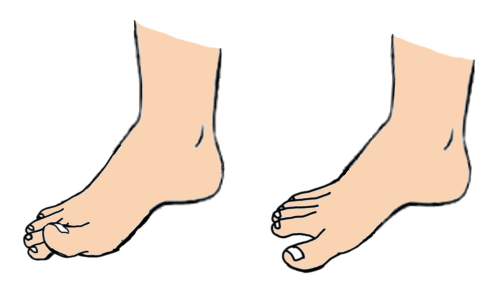 Foot Muscle Weakness and Flat Feet