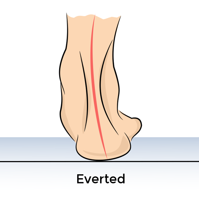 everted-heel-alignment
