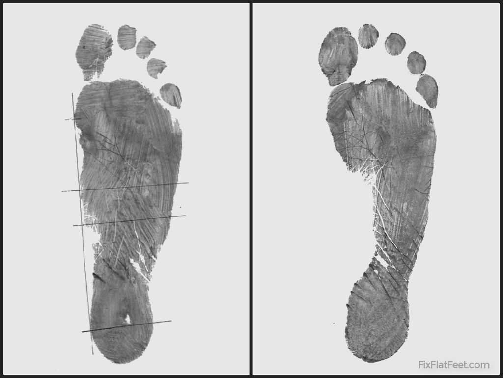 Flat foot footprint before and after