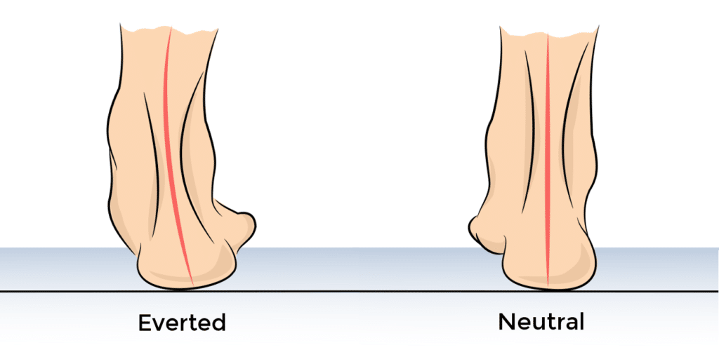 Everted Heel versus Neutral Heel Position