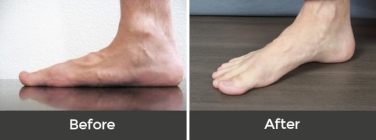 Flat Feet Correction Before and After