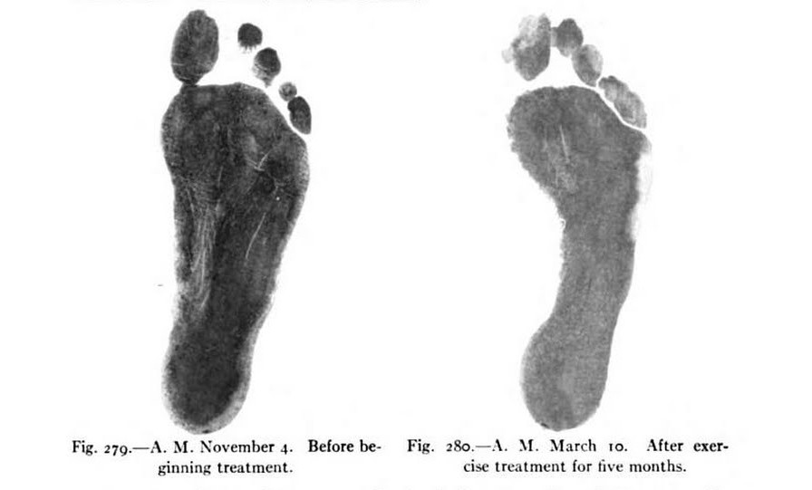 Foot print progress with exercise